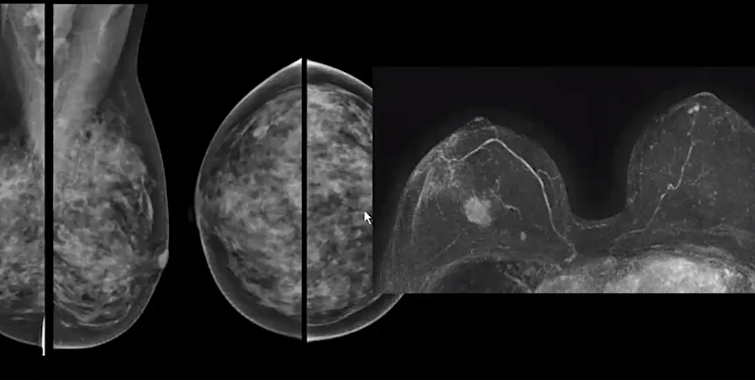 ΚΑΡΚΙΝΟΣ ΤΟΥ ΜΑΣΤΟΥ ΚΑΙ ΜΑΓΝΗΤΙΚΗ ΤΟΜΟΓΡΑΦΙΑ ΜΑΣΤΩΝ