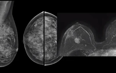 ΚΑΡΚΙΝΟΣ ΤΟΥ ΜΑΣΤΟΥ ΚΑΙ ΜΑΓΝΗΤΙΚΗ ΤΟΜΟΓΡΑΦΙΑ ΜΑΣΤΩΝ